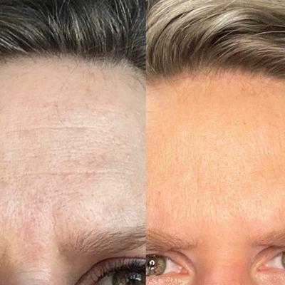 Before and after Botox and a serious moisturizing routine