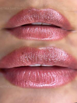 Dark Lip Neutralization Healed Result after three Sessions