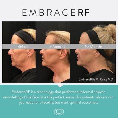 EmbraceRF is a revolutionary combination of #RFAL technologies
 
  FaceTite - minimally invasive treatment for facial contouring