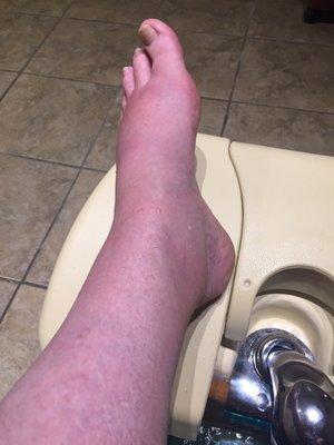 Injured, swollen foot /ankle