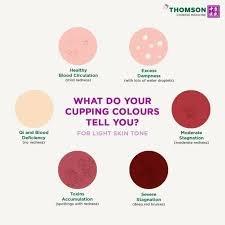 Cupping can be used for stagnant blood or stagnant lymph in the tissue.