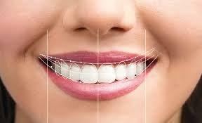 Custom Smile Design