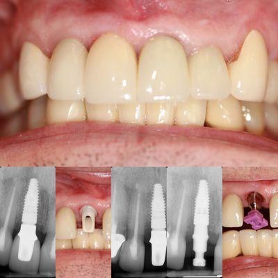 Broken front tooth restored with dental implant supported crown