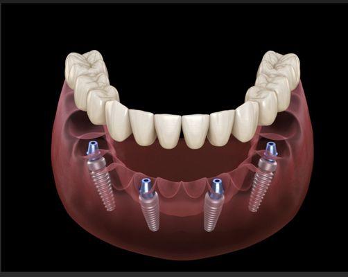 Smile with confident! Secure your denture with Implant