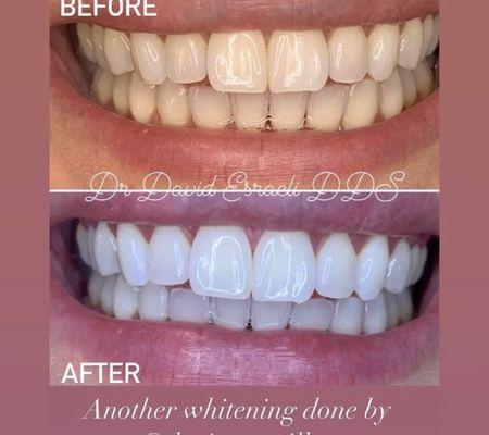 Teeth whitening