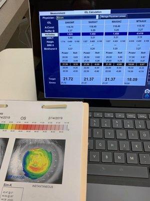 A-scan ultrasound for cataract surgery calculations