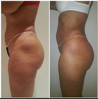 Cellulite treatment tone and lift