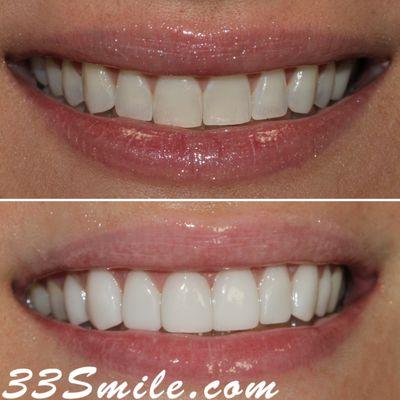 Prepless Veneers!