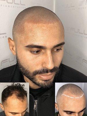 Scalp Micro Pigmentation