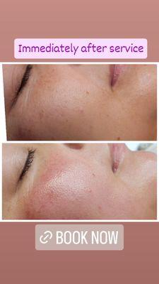 Microneedling and XPeeL5 immediately after service.