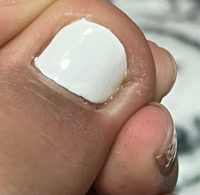 Infected toenail.