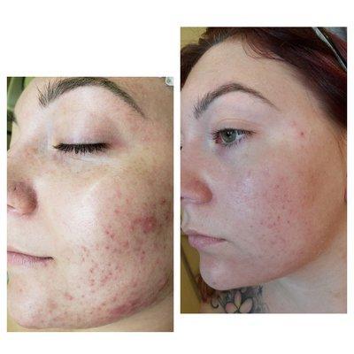 Before & after one chemical peel session.