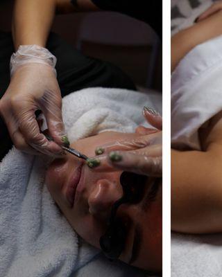 Dermaplane Treatment