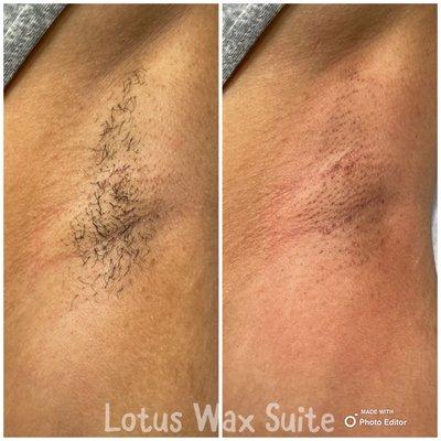 Before and after underarm wax