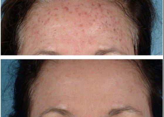 Sun damage is reversible with our IPL laser! Call for a consultation to see if you're a candidate!