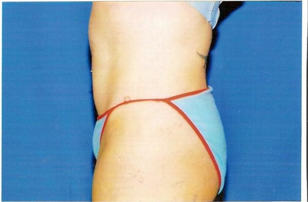 Liposuction side view After