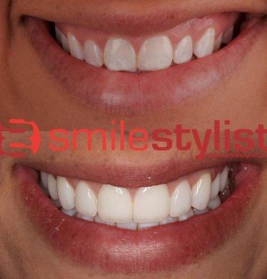 B&A Veneers