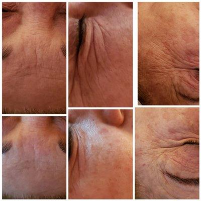 Anti-aging treatment,  you can definitely see the fine line is reduced. And the skin is plumping out.