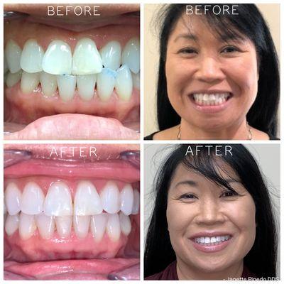 Before/After Invisalign by Dr. Pinedo