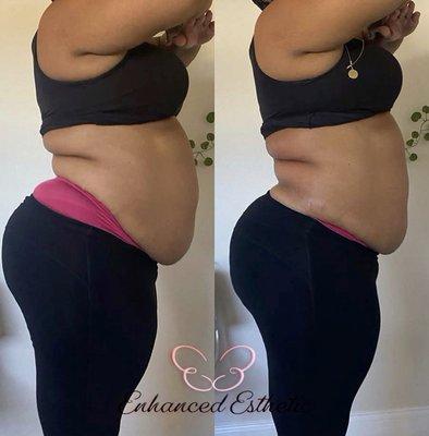 Instant Buttocks Lift & Lipo Cavitation results. Clients will continue to see results up to 7 days after their treatment.