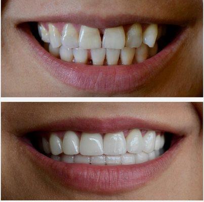 16 veneers to restore this smile