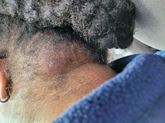 Cellulitis infection after braids in for 2 weeks