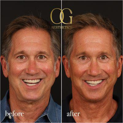 This gentleman was bothered by his neck and jawline. He is now 3 months healed from his extended deep plane face and neck lift.