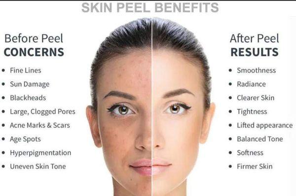 Benefits of Anti-Aging Enzymatic Peels