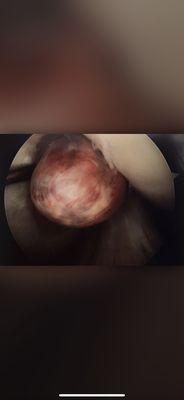 Rare knee tumor misdiagnosed by SCOI