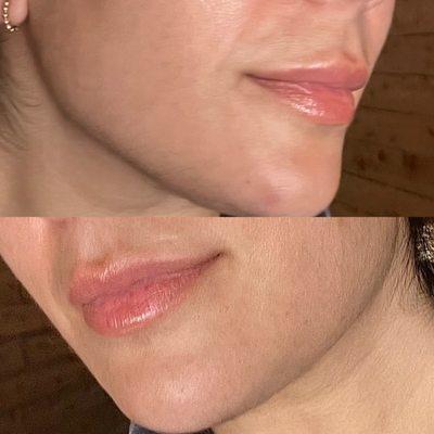 Lip filler