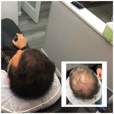 Scalp Micro Pigmentation