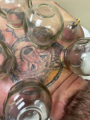 Mechanical Accupuncture , Glass Cupping ( Bentosa)  , Hilot  ( native massage)