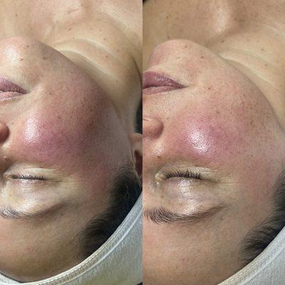 Before and after rosacea client