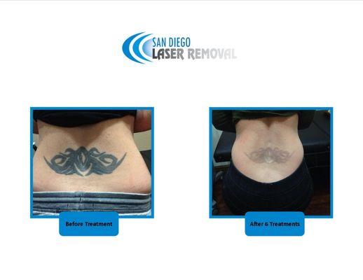 Tattoo Removal San Diego