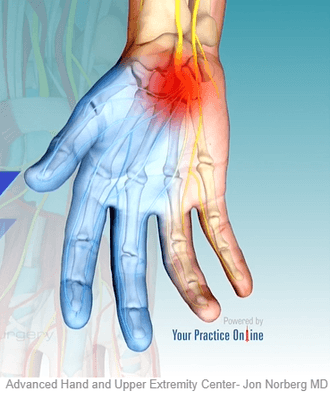 Carpal Tunnel Syndrome