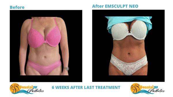 Emsculpt Neo Results