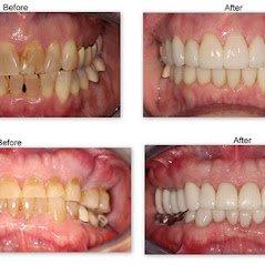 Dental Crowns