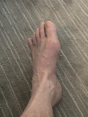 Another view of healed foot