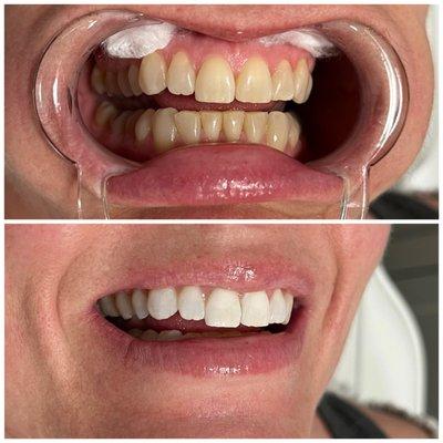 Extreme whitening plus