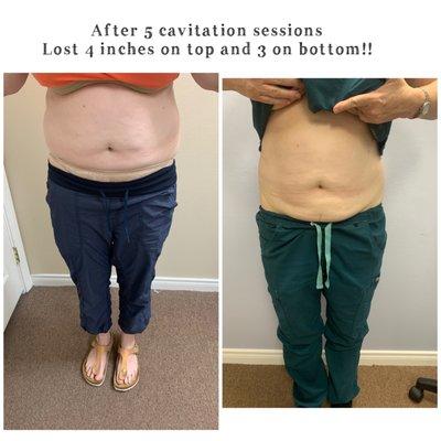 Cavitation for inches lost!