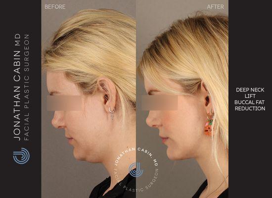 Deep neck lift with deep structural contouring, combined with buccal fat reduction to create a more defined jawline