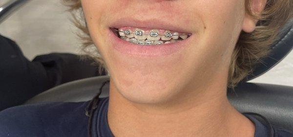 Braces!!