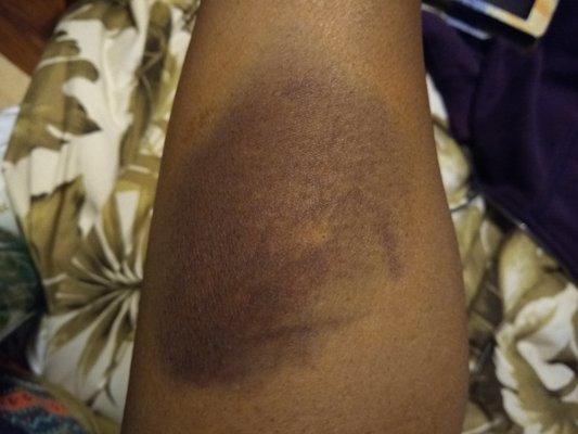 I ask the nurse if she knew how to give an I-V. She said Yes, I do it 5 times a day. 
 This is my arm after her unsuccessful try.