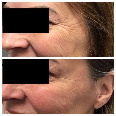 Lateral Canthal Lines ("Crow's Feet") significantly reduced after Botox