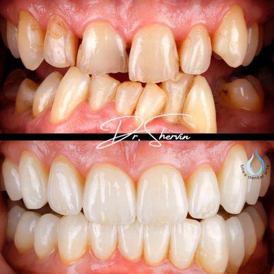 Missing teeth, Misaligned teeth. Align therapy, cosmetic dentistry (Invisalign, combo bridge crowns,implant, veneers) by Dr. Shervin.