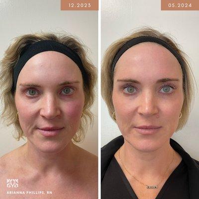 We are obsessing over these Fotona results - 4 treatments in one, wow!