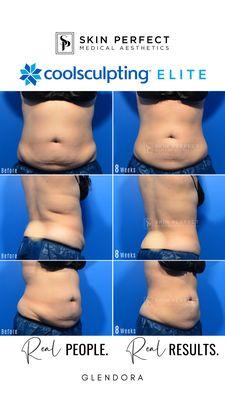 Before / Afters of an actual employee at Skin Perfect Medical Glendora! Come in ask her about how CoolSculpting works!