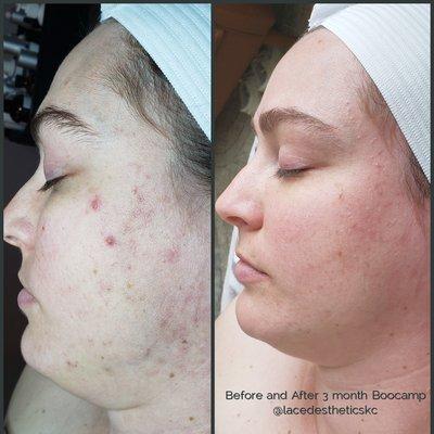 Try the 3 month bootcamp to clear acne fast!