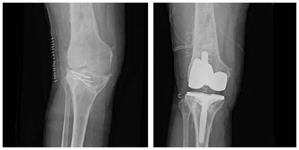 Complex Total Knee Arthroplasty