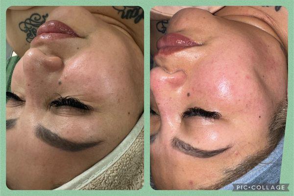 Microdermabrasion facial